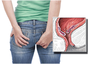 Obat untuk wasir keluar darah, cara mengatasi wasir ibu hamil, jual obat penyakit wasir di sawahlunto, obat untuk penyakit wasir wasir wasir, cara mengobati ambeyen atau wasir, tanda penyakit ambeyen, obat mengurangi bengkak wasir atau ambeien, bahaya penyakit wasir pada ibu hamil, obat buat penyakit wasir di surabaya, obat untuk mengobati wasir di lahat, cara mengatasi wasir kumat